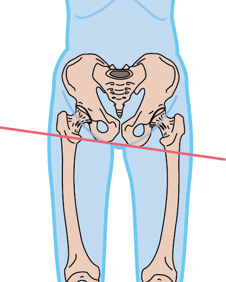 骨盤の歪み前後